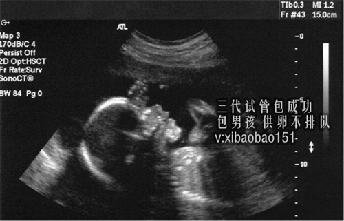 上海65万代生何止伤钱,试管婴儿失败的原因都有